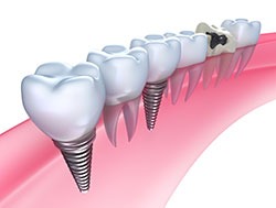Cosmetic-Dentistry---Implants-by-Cosmetic-Dental-of-Encino-(4)