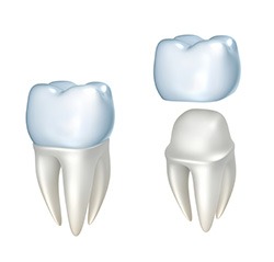 General-Dentistry-Crowns-by-Cosmetic-Dental-of-Encino-1