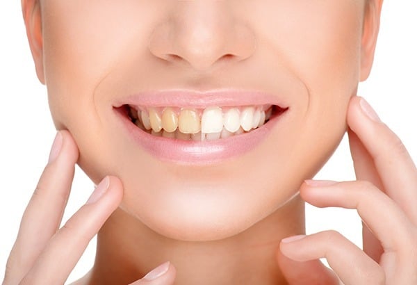 teeth-whitening2015b30-11
