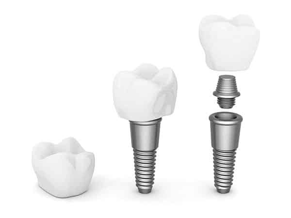 dental-implants201512
