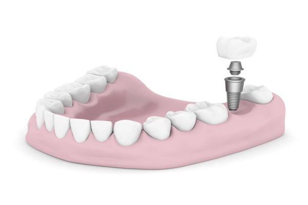 dental-implants20161