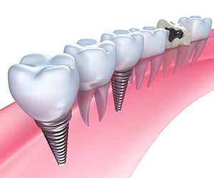 Cosmetic-Dentistry-Implants-by-Cosmetic-Dental-of-Encino-tn