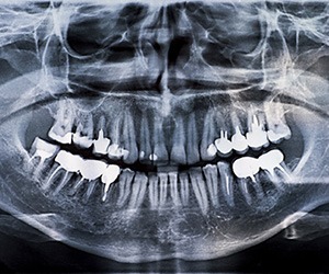 General-Dentistry-Fillings-by-Cosmetic-Dental-of-Encino-tn