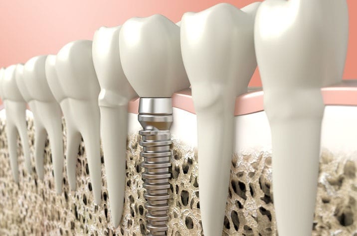 how-can-dental-implants-help-me