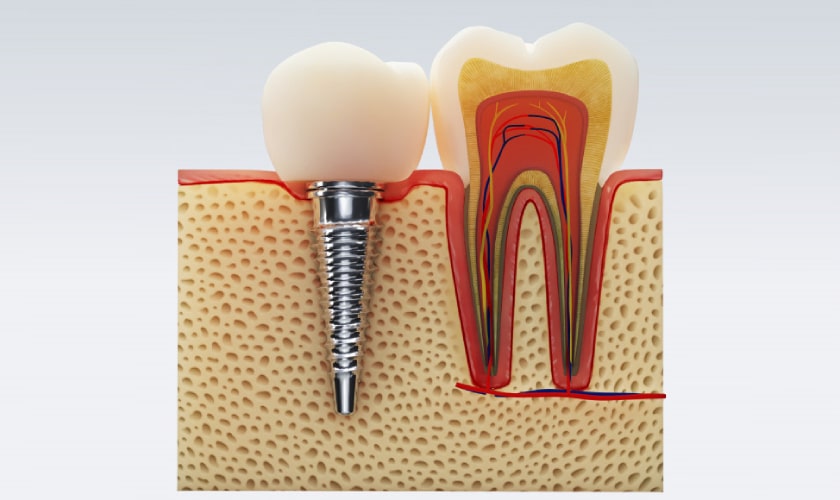 Root Canal Therapy Encino