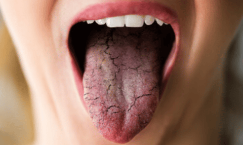 know about dry mouth