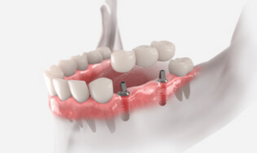 dental bridge information