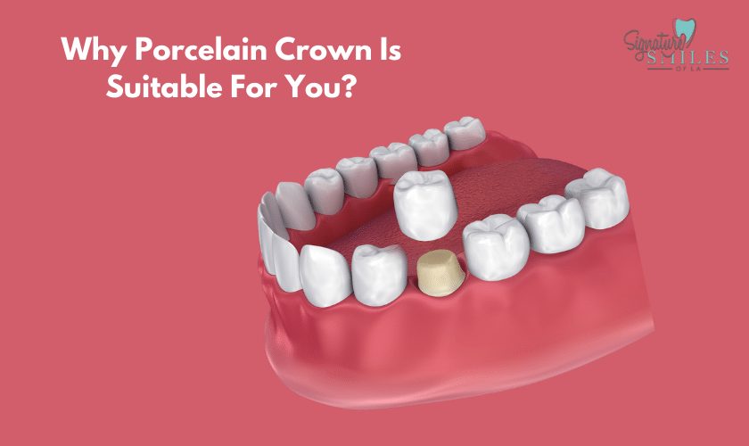 Porcelain Dental Crowns Encino