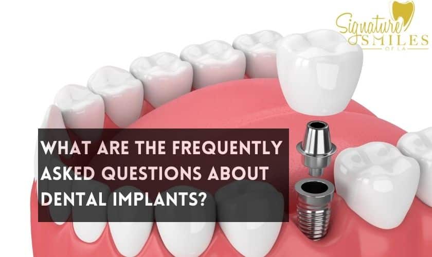 Dental Implant in Encino