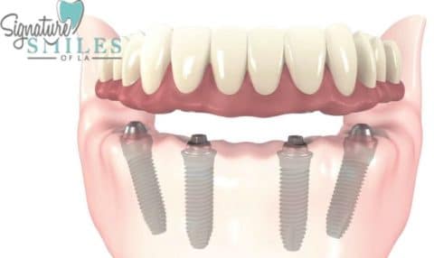 dental implants Encino
