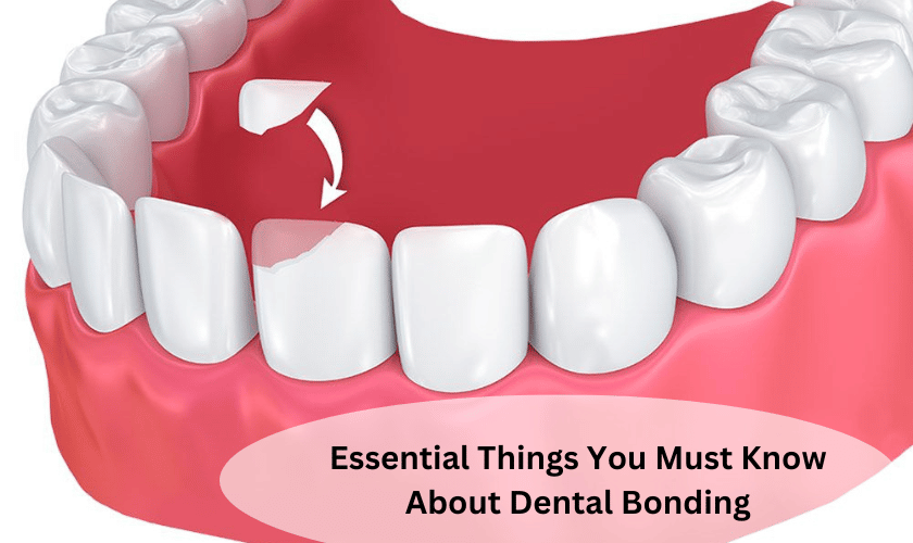 Essential Things You Must Know About Dental Bonding
