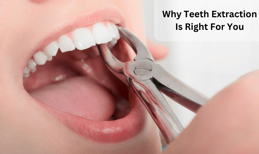 Why Teeth Extraction Is Right For You