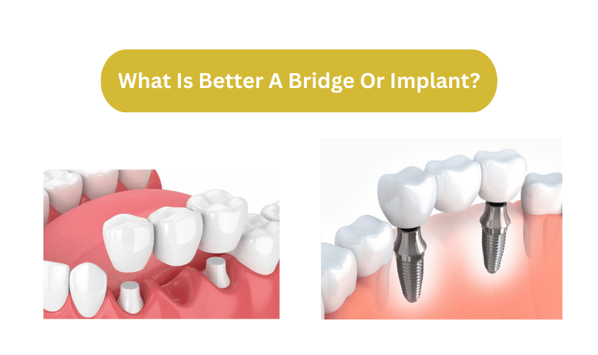 What Is Better A Bridge Or Implant?