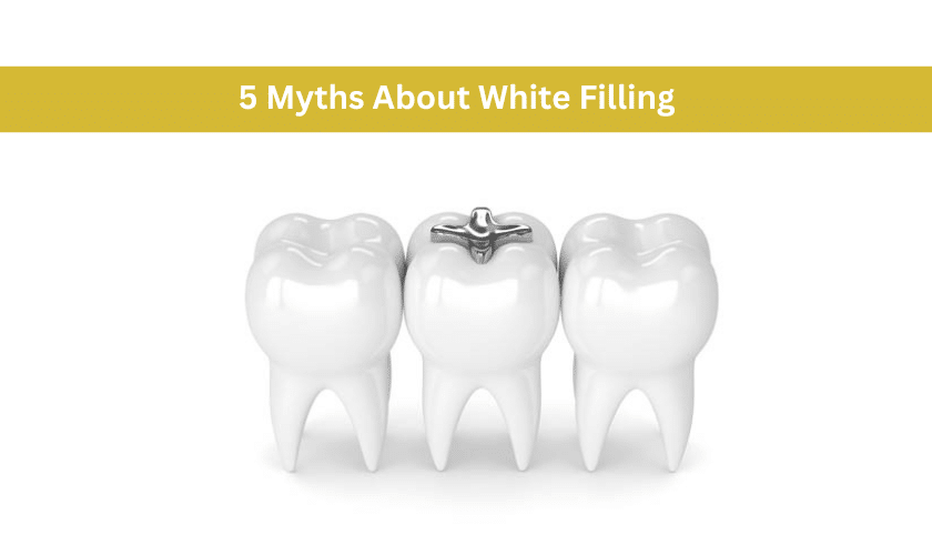 5 Myths About White Filling