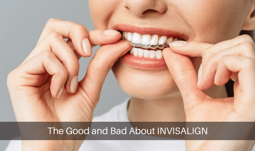 The Good and Bad About INVISALIGN