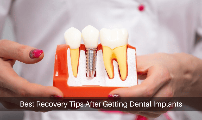 Best Recovery Tips After Getting Dental Implants