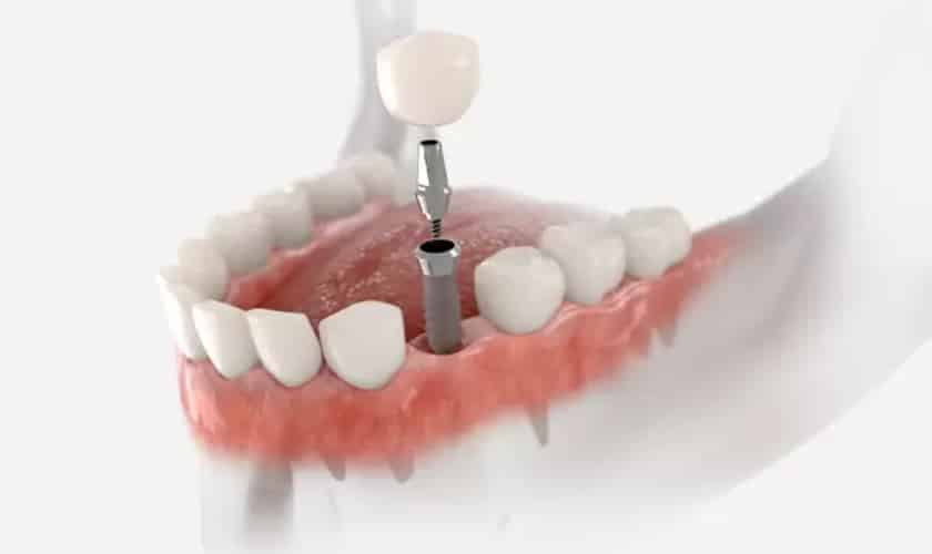 dental implant encino-signature smiles of encino-why dental implants are a permanent solution to missing teeth