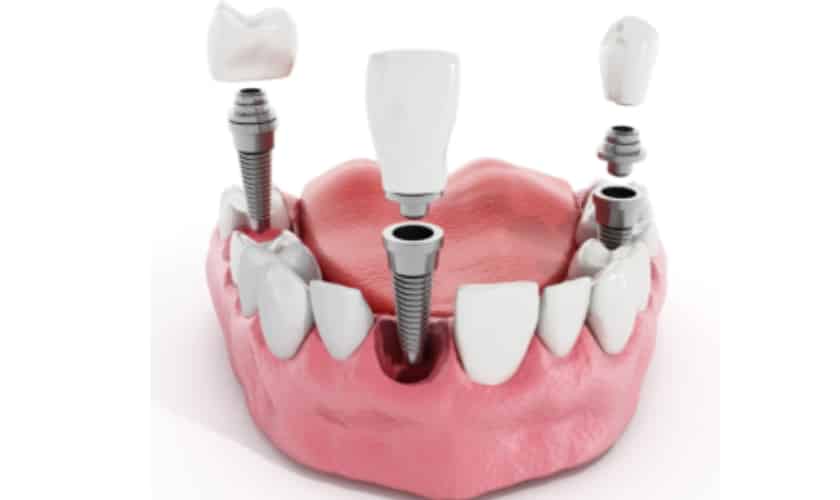 Image of dental implant-understanding dental implant procedure step by