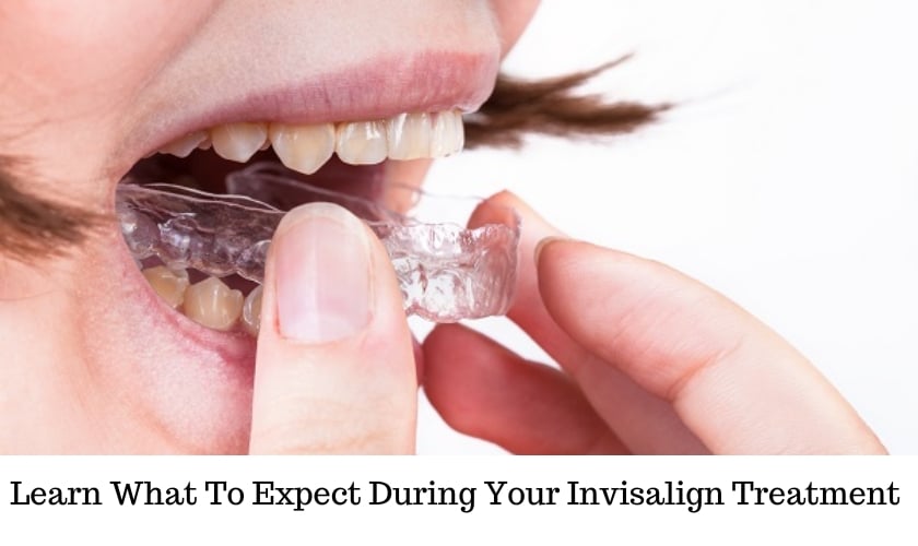 Image of what to expect during your invisalign treatment
