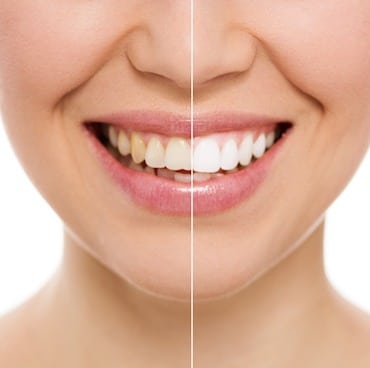 Teeth Whitening - Dentist Encino
